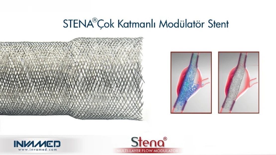 Aort anevrizmasına STENA stent tedavisi