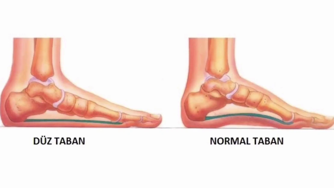 Düz tabanlığa sahip hastalara nadir de olsa ameliyat önerebiliyoruz