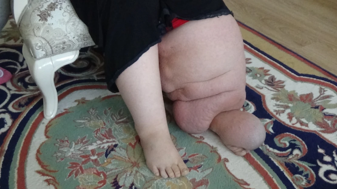 Fil hastalığı ilerlemeden tedavi edilmeli