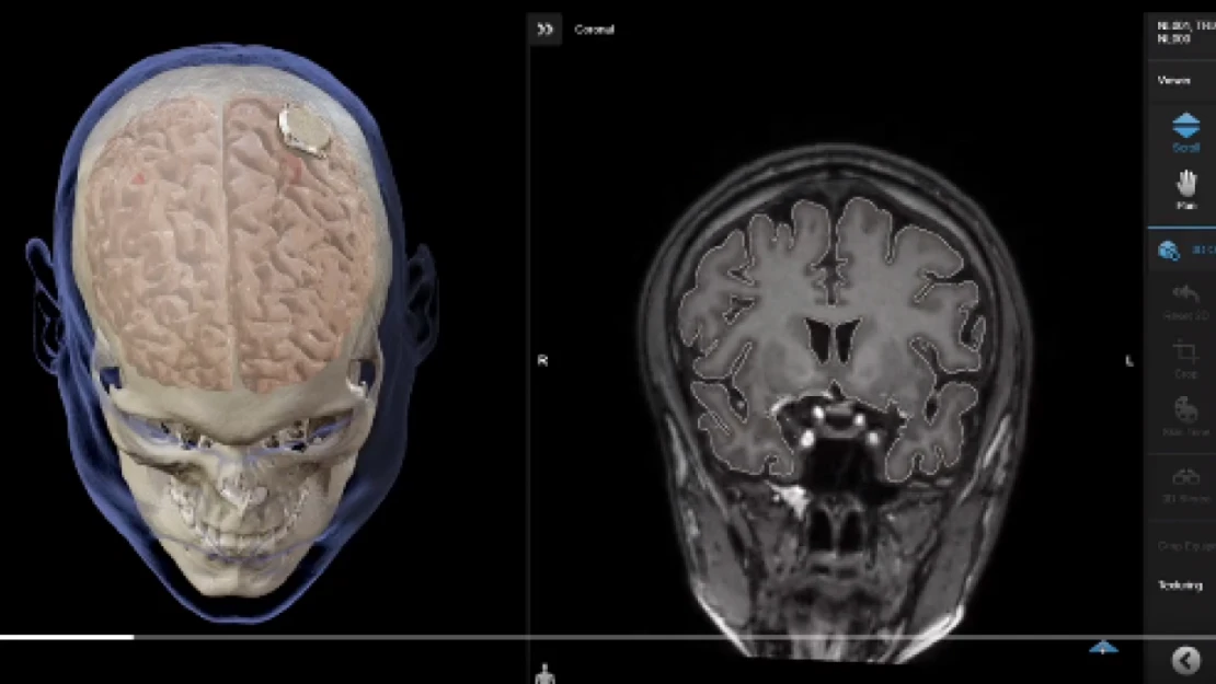 Neuralink, Beyin İmplantı Denemesi İçin İnsan İşe Alımına Yeşil Işık Yaktı