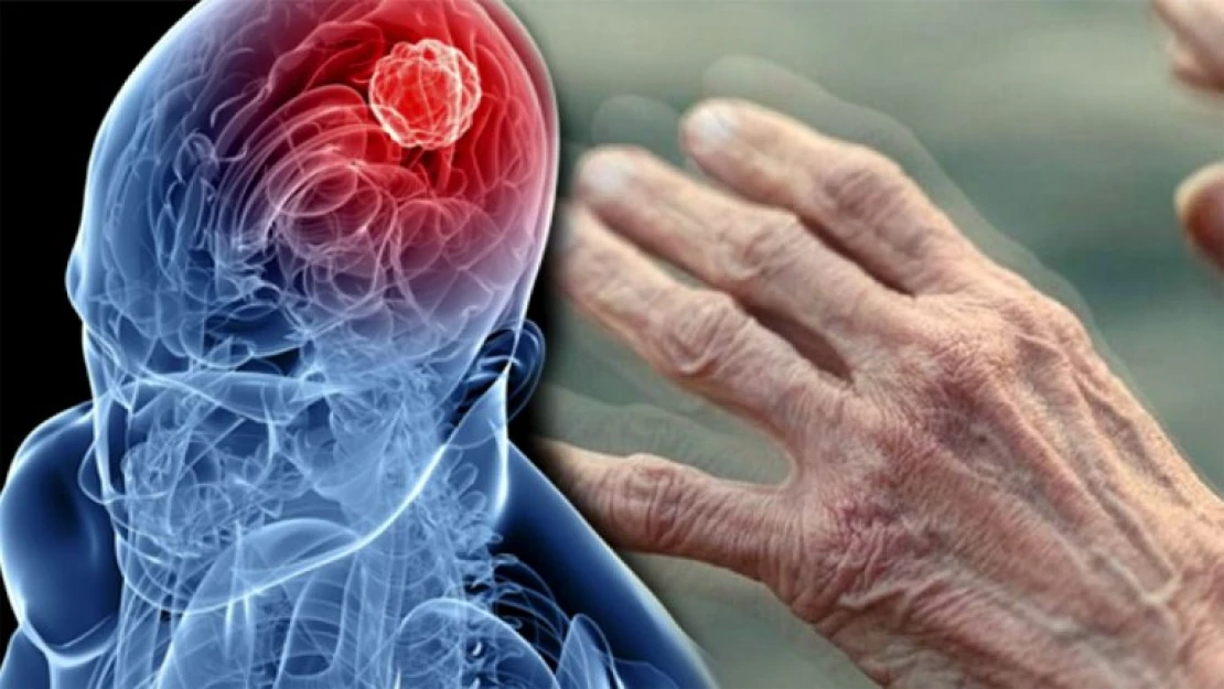 Parkinsonun en yaygın belirtisi istirahat halinde titremedir