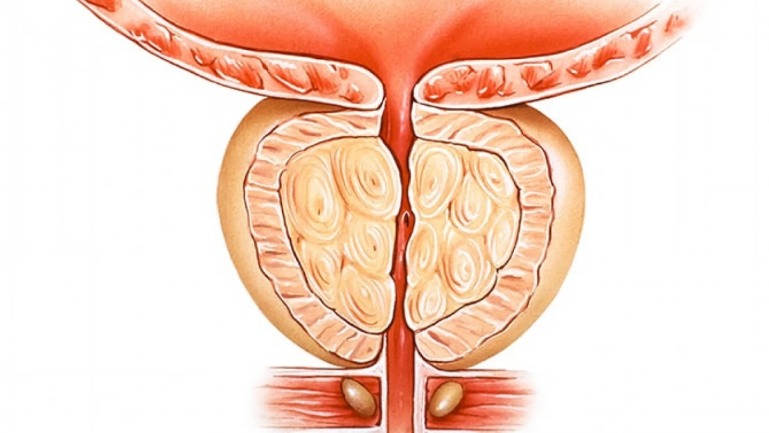 Prostat büyümesinin tedavisinde 'prostat arter embolizasyonu'