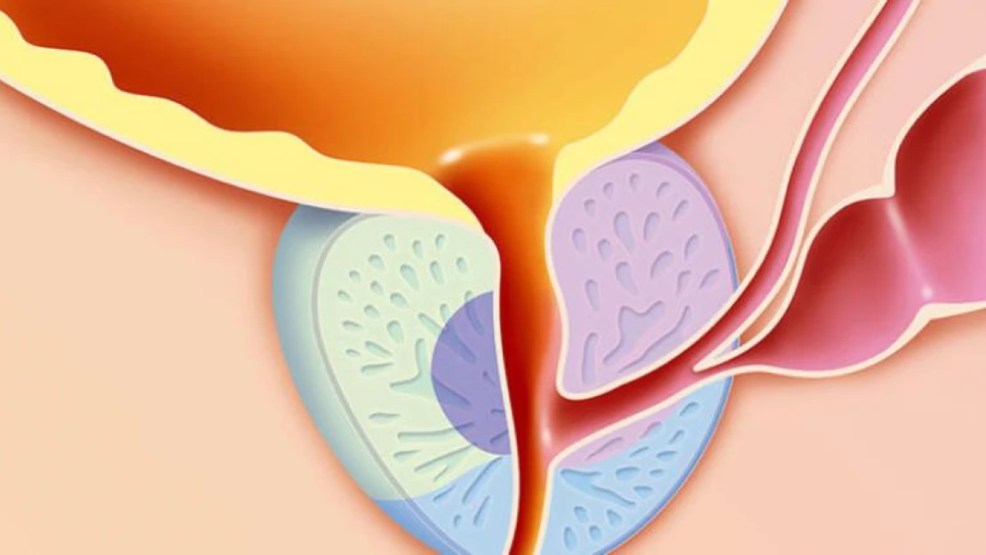 Prostat Kanserinin Başlıca 7 Belirtisi