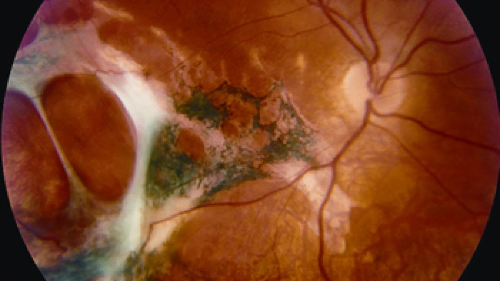 Göz ovuşturmak retina hasarına yol açabilir
