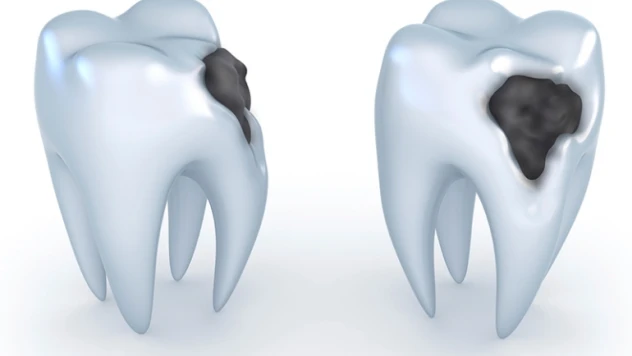 Ağız kokusu diş çürüğü belirtisi olabilir