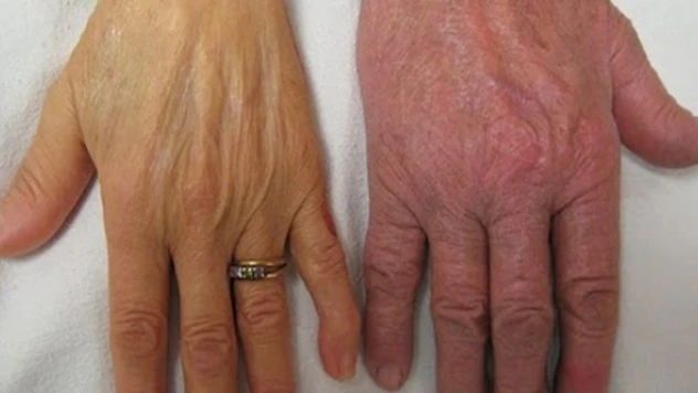 Akdeniz anemisine karşı çözüm önerisi