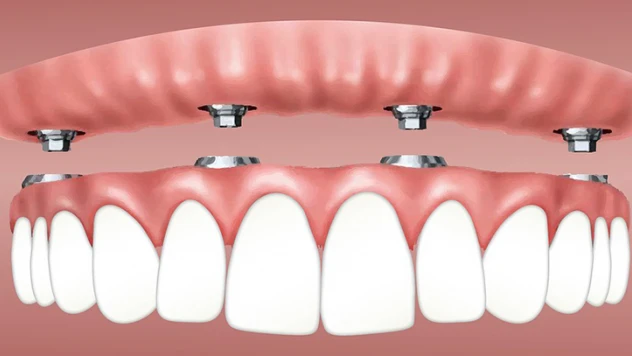 All on four implant tedavisi ile yaşam kalitesi yükseliyor