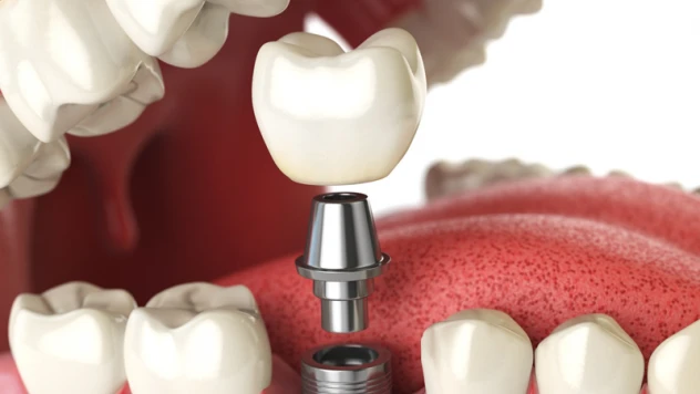 Diş hekimi uyardı: 'İmplant ömür boyu kullanılabilir'