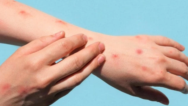 Fransız eşcinseller maymun çiçeği virüsü pençesinde