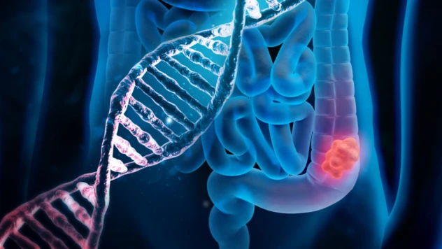 Kolon kanserinden korunmada beslenme çok önemli