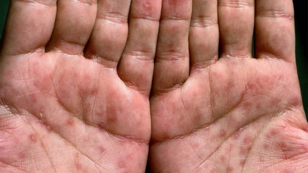 Türkiye'de günde 10 kişi HIV ile enfekte oluyor