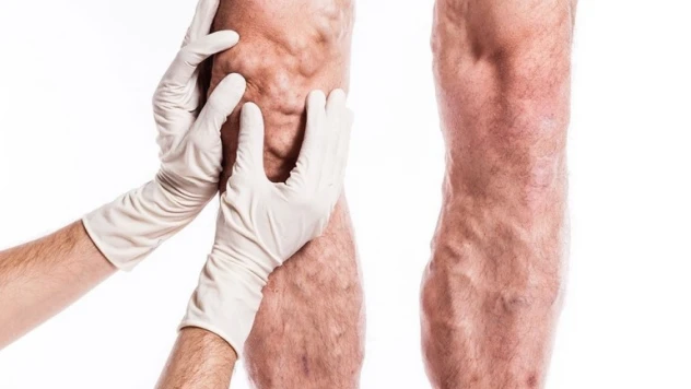 Varislerden ameliyatsız kurtulmak mümkün