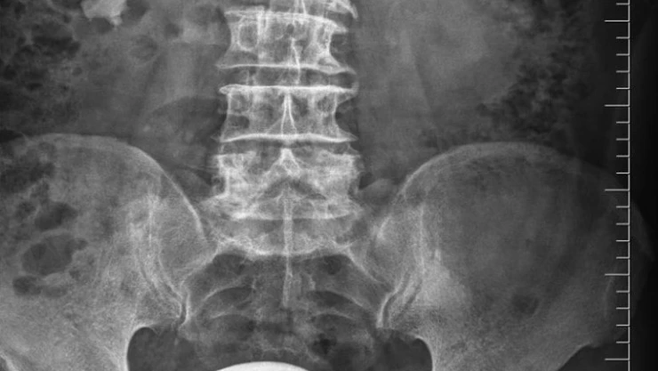 Mesaneden çıkan taş  şaşırttı