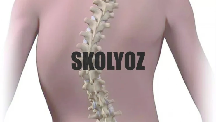'Skolyozdan korkmayın, geç kalmaktan korkun'