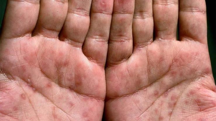 Türkiye'de günde 10 kişi HIV ile enfekte oluyor