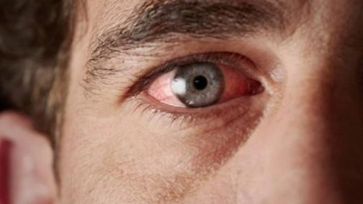 Uzmanı açıkladı, bu belirtiler varsa şaşı olabilirsiniz